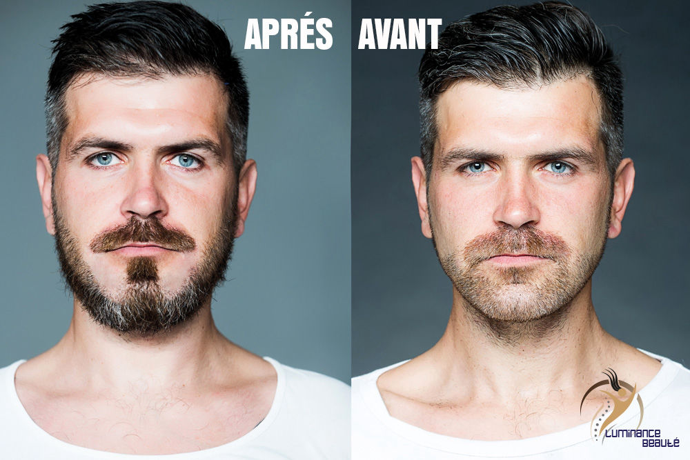 Photo greffe de barbe avant apres