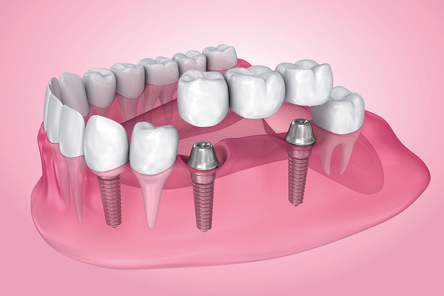 Photo Implant Dentaire